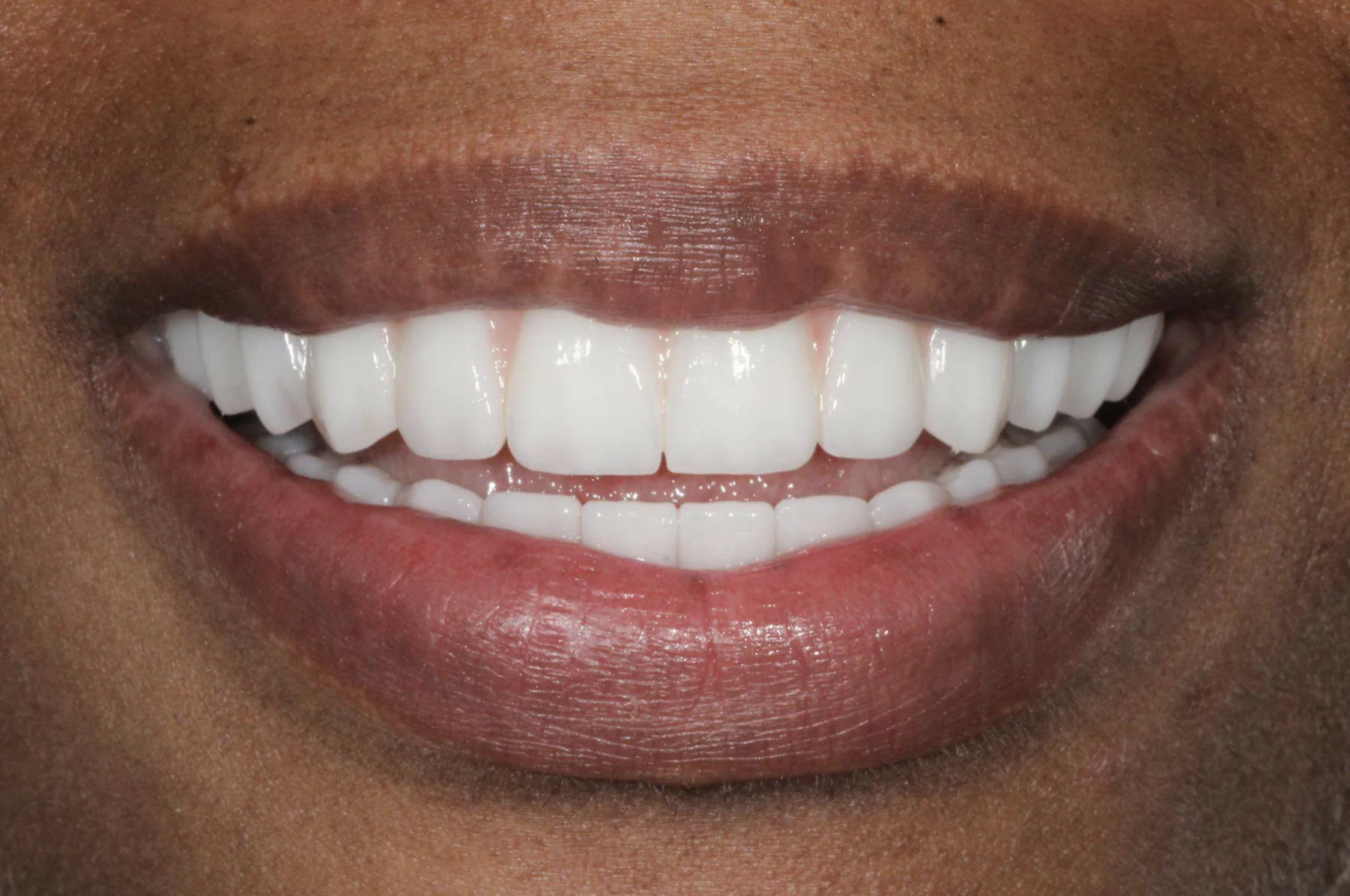 Restored smile after full mouth dental implants replaced missing teeth and corrected a gummy smile at Pearl Dental Group in Metairie, LA
