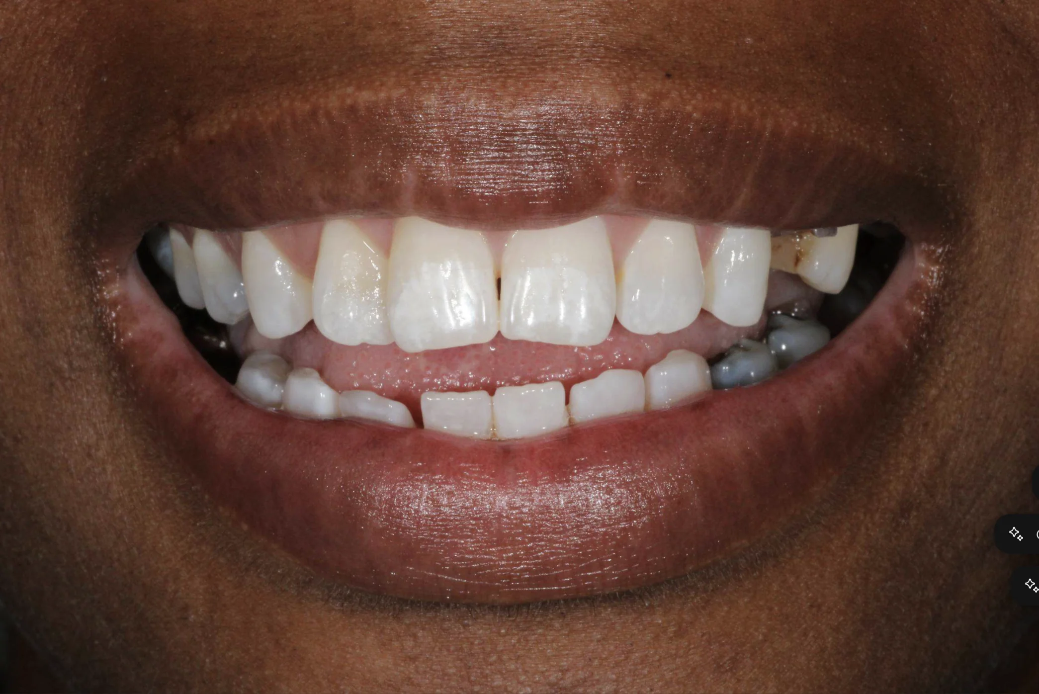 Multiple missing teeth and gummy smile before full mouth dental implant treatment at Pearl Dental Group in Metairie, LA