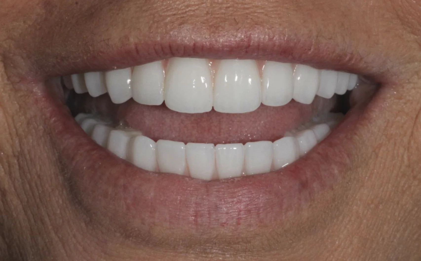 Restored smile after All-on-X dental implants replaced old crowns and bridges at Pearl Dental Group in Metairie, LA