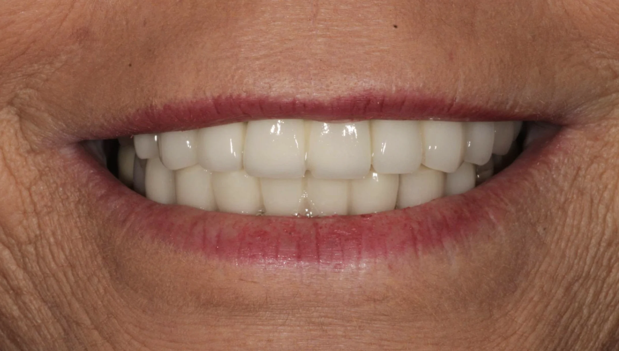 Old dental crowns and bridges before All-on-X dental implant treatment at Pearl Dental Group in Metairie, LA