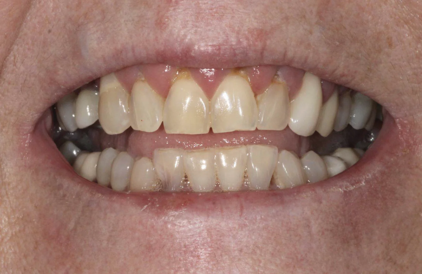 Crooked, decayed and loose teeth before All-on-4 dental implant treatment at Pearl Dental Group in Metairie, LA