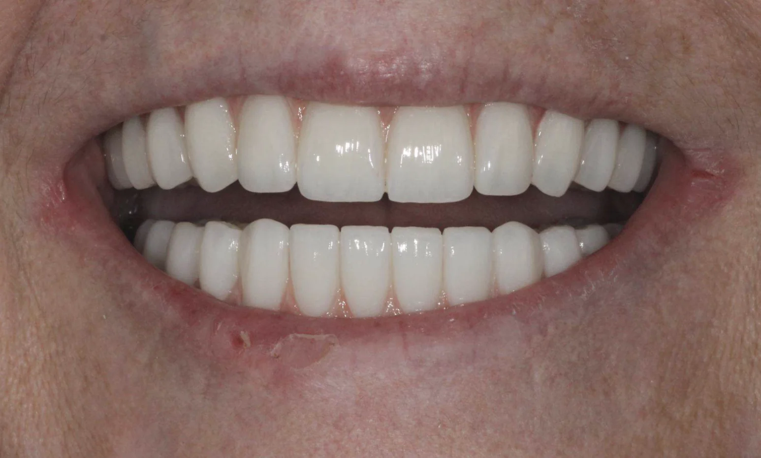 Restored smile after All-on-4 dental implants replaced crooked, decayed and loose teeth at Pearl Dental Group in Metairie, LA