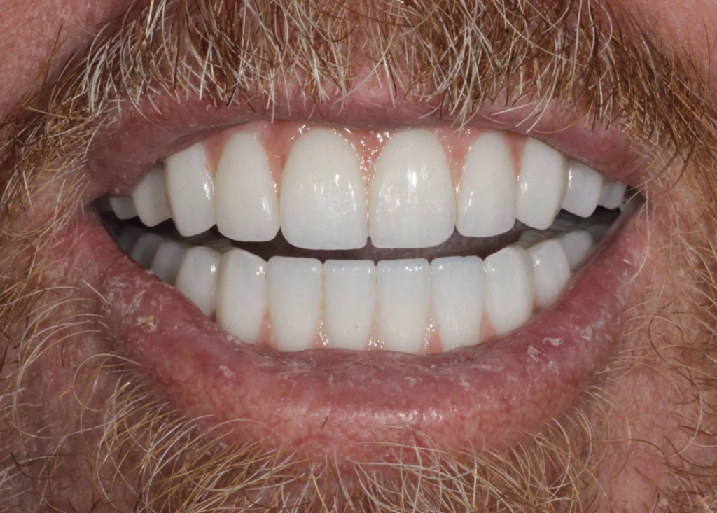 Restored smile after same-day full mouth dental implant treatment for severe gum disease at Pearl Dental Group in Metairie, LA