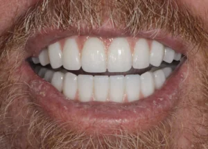 Restored smile after same-day full mouth dental implant treatment for severe gum disease at Pearl Dental Group in Metairie, LA
