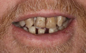 Teeth with severe gum disease before same-day full mouth dental implant treatment at Pearl Dental Group in Metairie, LA