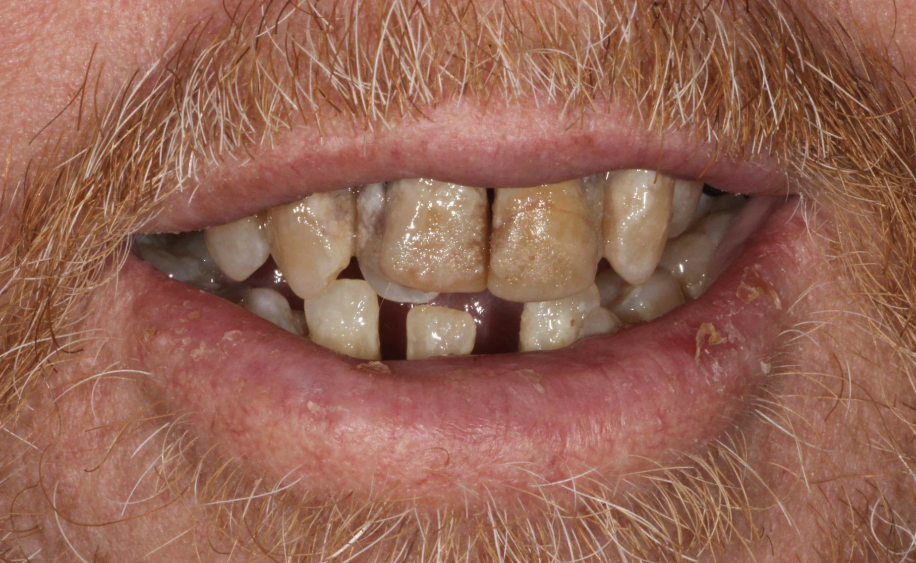 Teeth with severe gum disease before same-day full mouth dental implant treatment at Pearl Dental Group in Metairie, LA