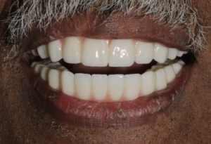 Permanent zirconia implant teeth replacing decayed and loose teeth at Pearl Dental Group in Metairie, LA