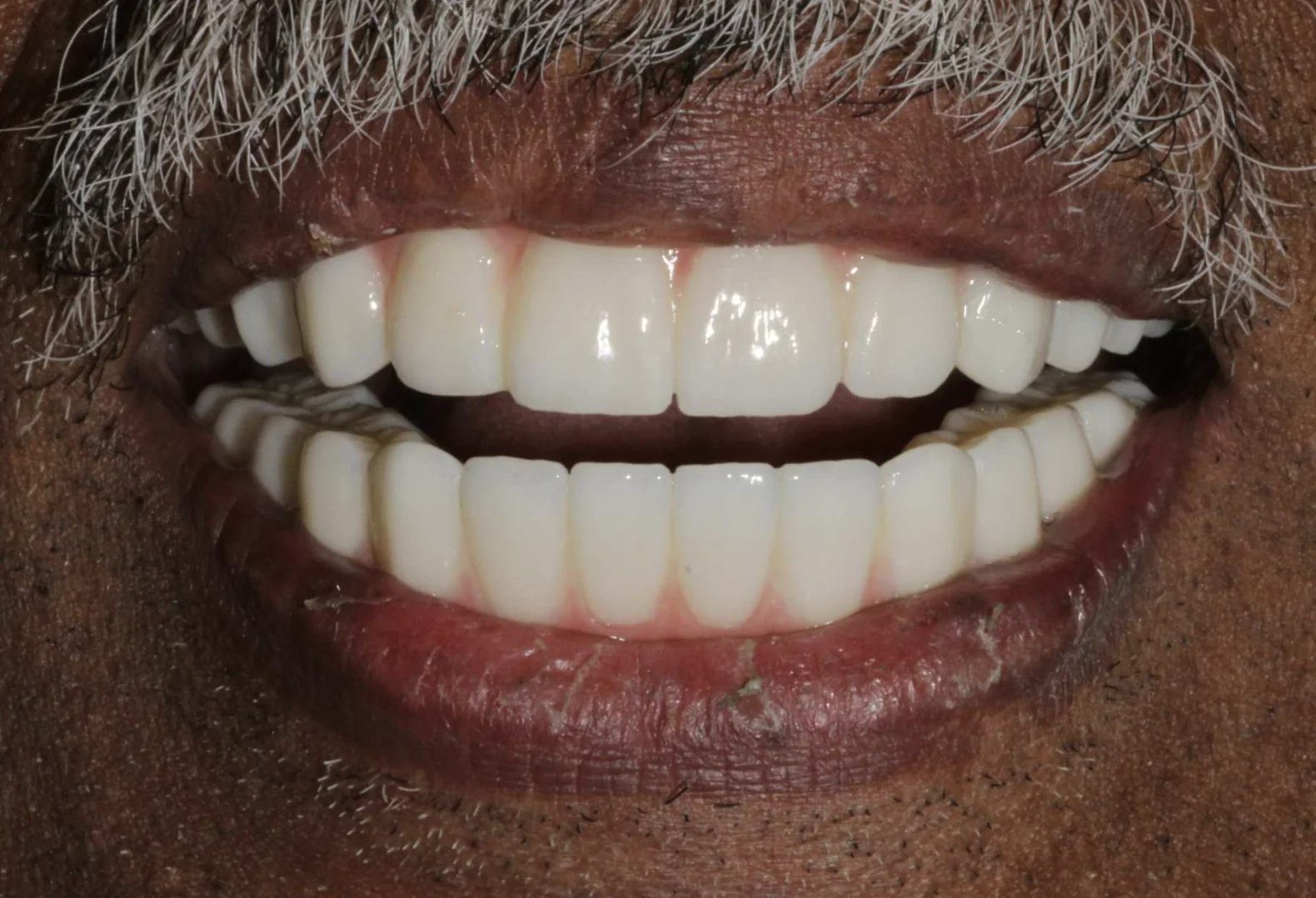 Permanent zirconia implant teeth replacing decayed and loose teeth at Pearl Dental Group in Metairie, LA