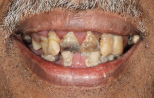 Decayed and loose teeth before full mouth dental implant treatment at Pearl Dental Group in Metairie, LA