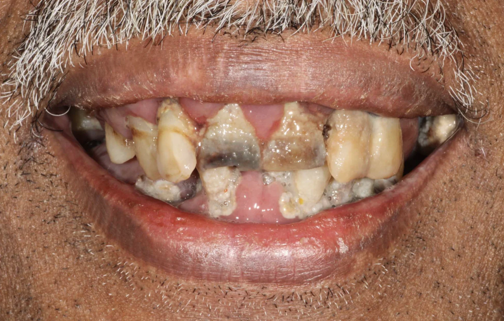 Decayed and loose teeth before full mouth dental implant treatment at Pearl Dental Group in Metairie, LA
