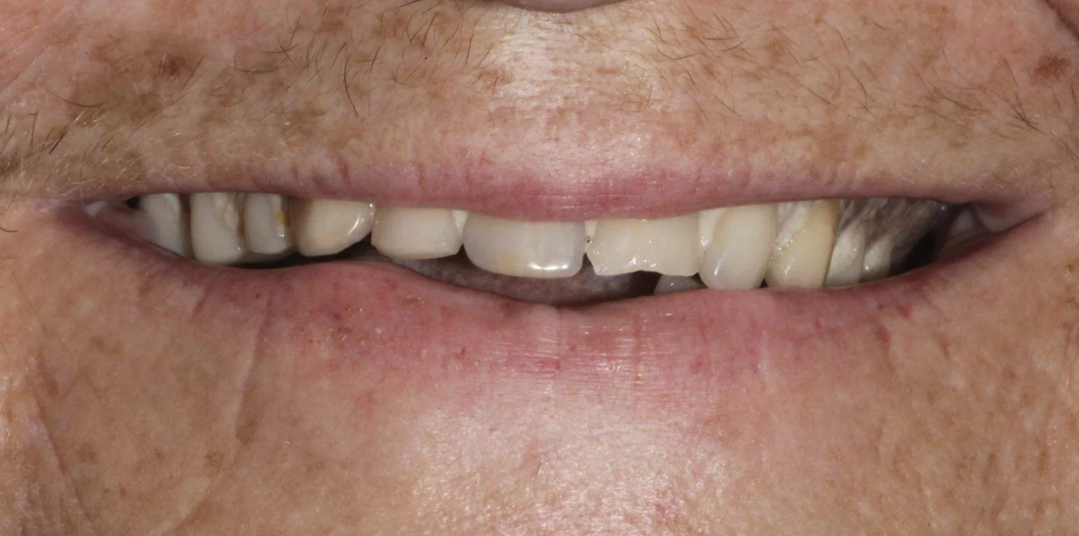Old uncomfortable dentures before full mouth dental implant treatment at Pearl Dental Group in Metairie, LA