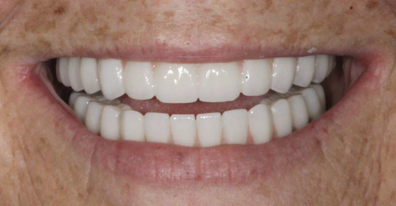 Permanent zirconia implant teeth replacing old uncomfortable dentures at Pearl Dental Group in Metairie, LA