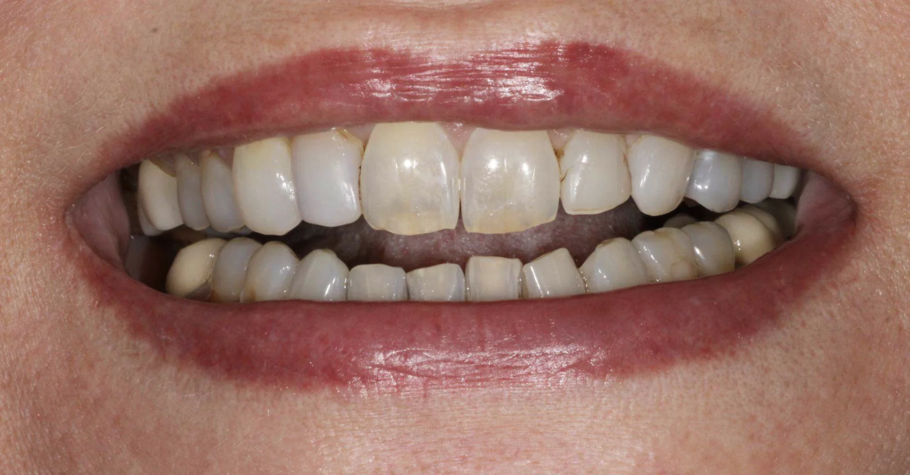Worn and discolored teeth before full mouth reconstruction with zirconia crowns at Pearl Dental Group in Metairie, LA