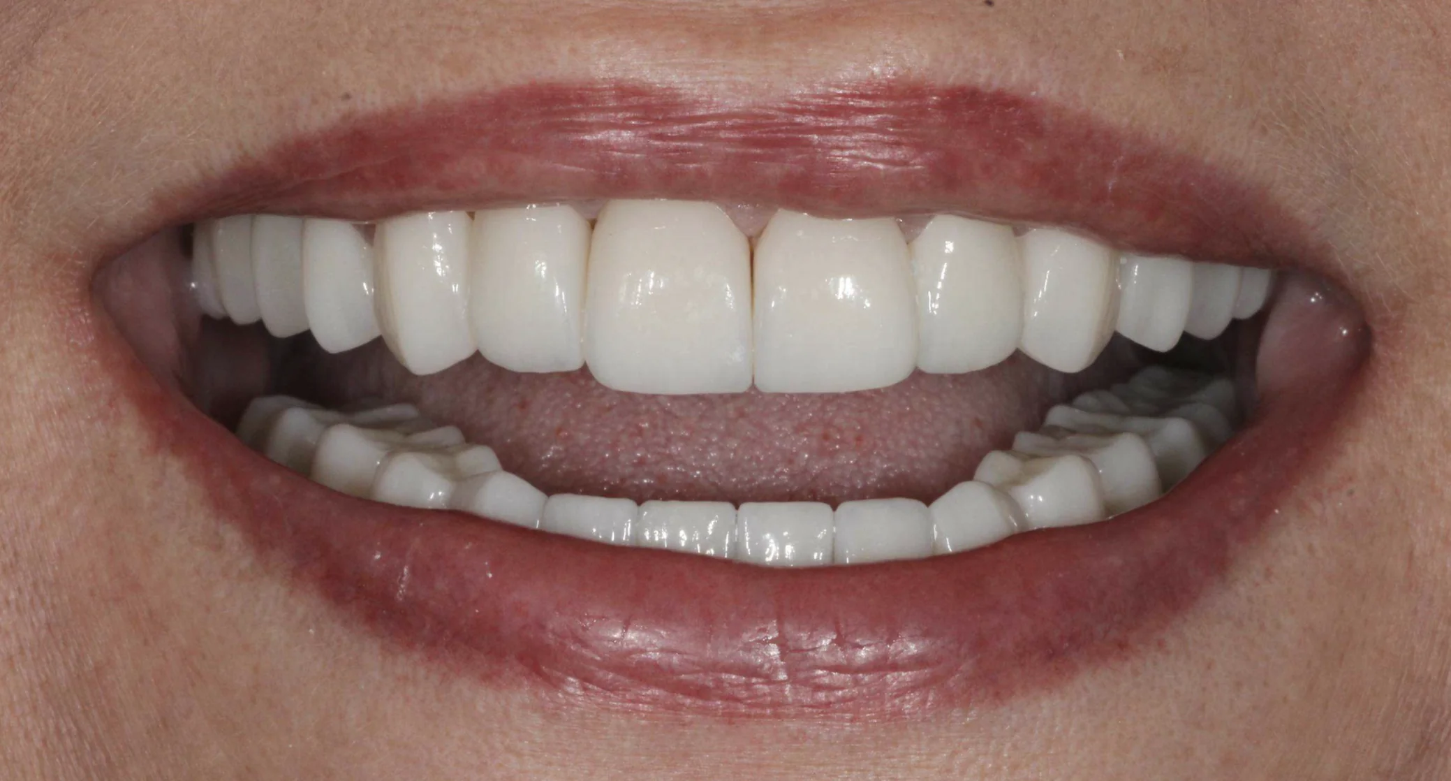 Restored smile after full mouth reconstruction with zirconia crowns at Pearl Dental Group in Metairie, LA