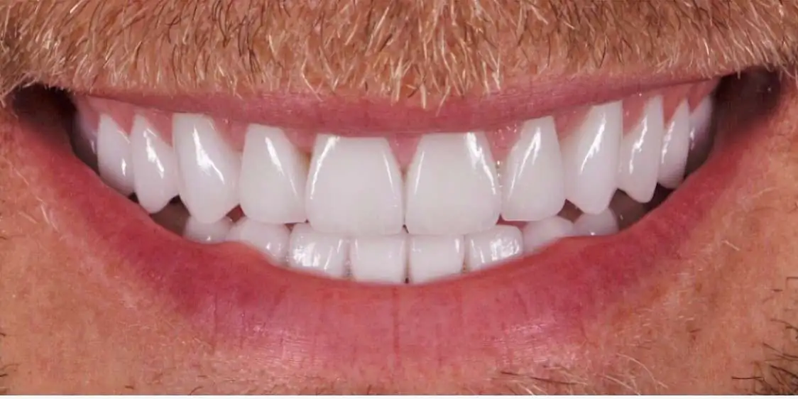 teeth5-after