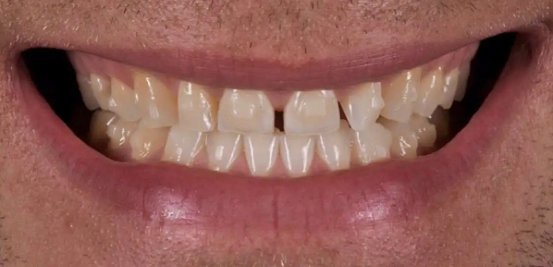 teeth5