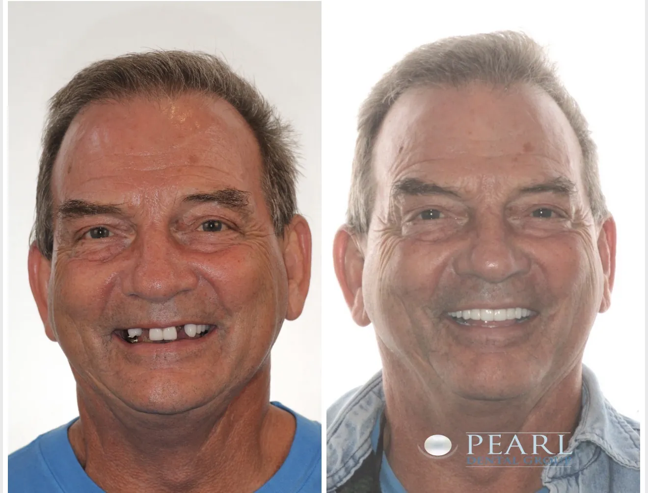 Man before and after full-mouth dental implants at Pearl Dental Group, showing missing teeth on the left and a restored smile on the right.